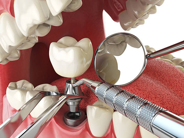 Best Emergency Root Canal Treatment in Sughter, LA